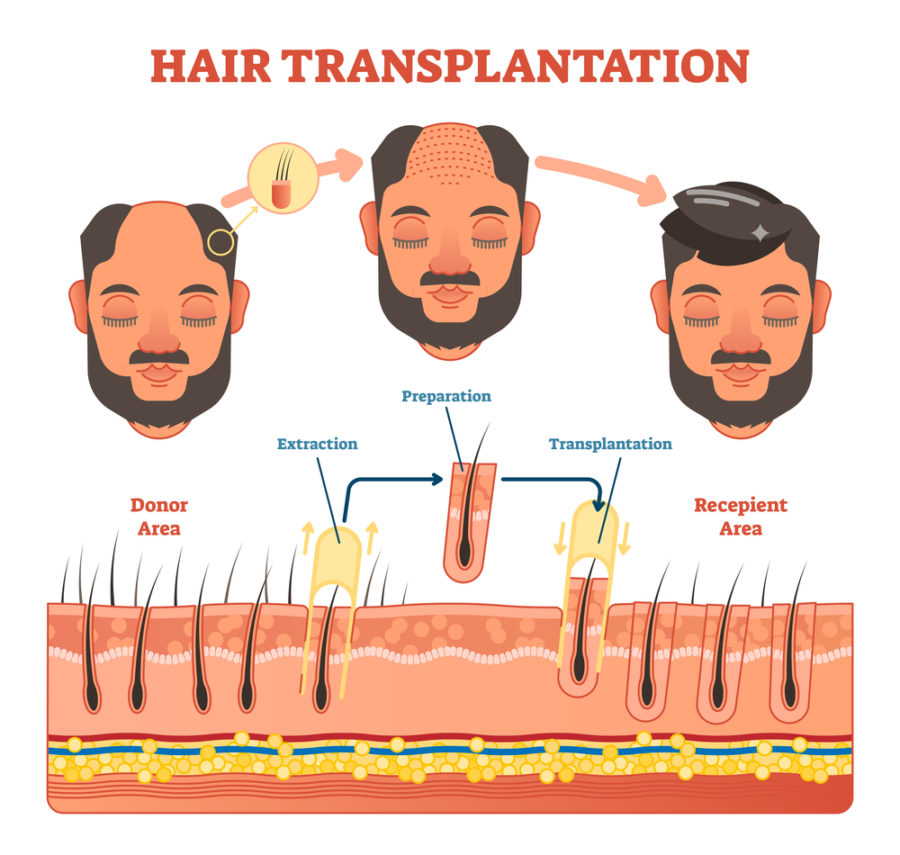 steps of hair transplant operation
